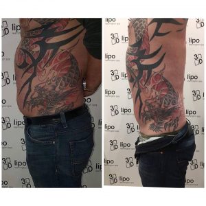 Bespoke Fat Reduction Before and After - 3D-lipo Leamington Spa