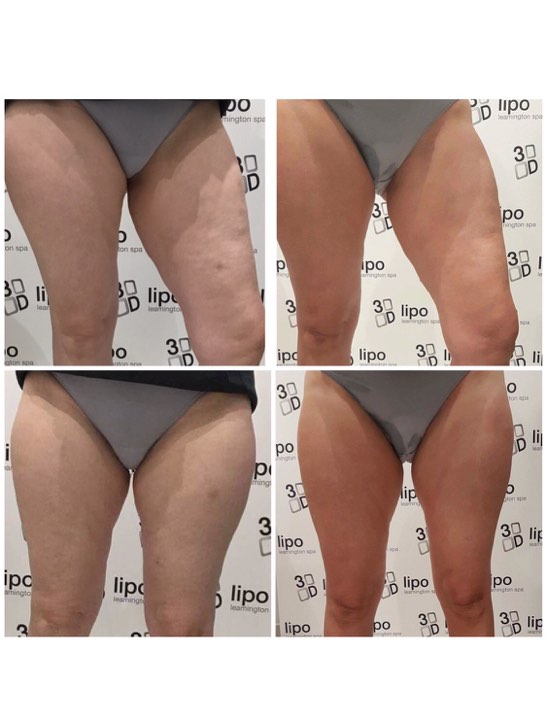 after 3d lipo
