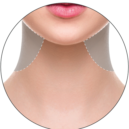 3D HIFU Face treatment at 3d lipo leamington