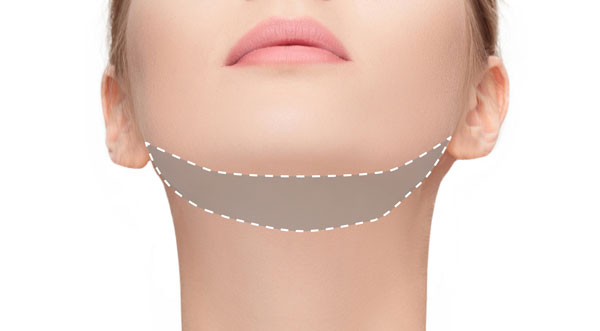 3D Chin Cryofreeze treatment at 3d lipo leamington