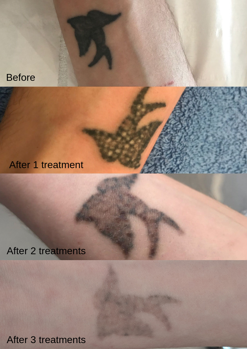 Laser Tattoo Removal at 3D Aesthetics Leamington Spa treatment at 3d lipo leamington