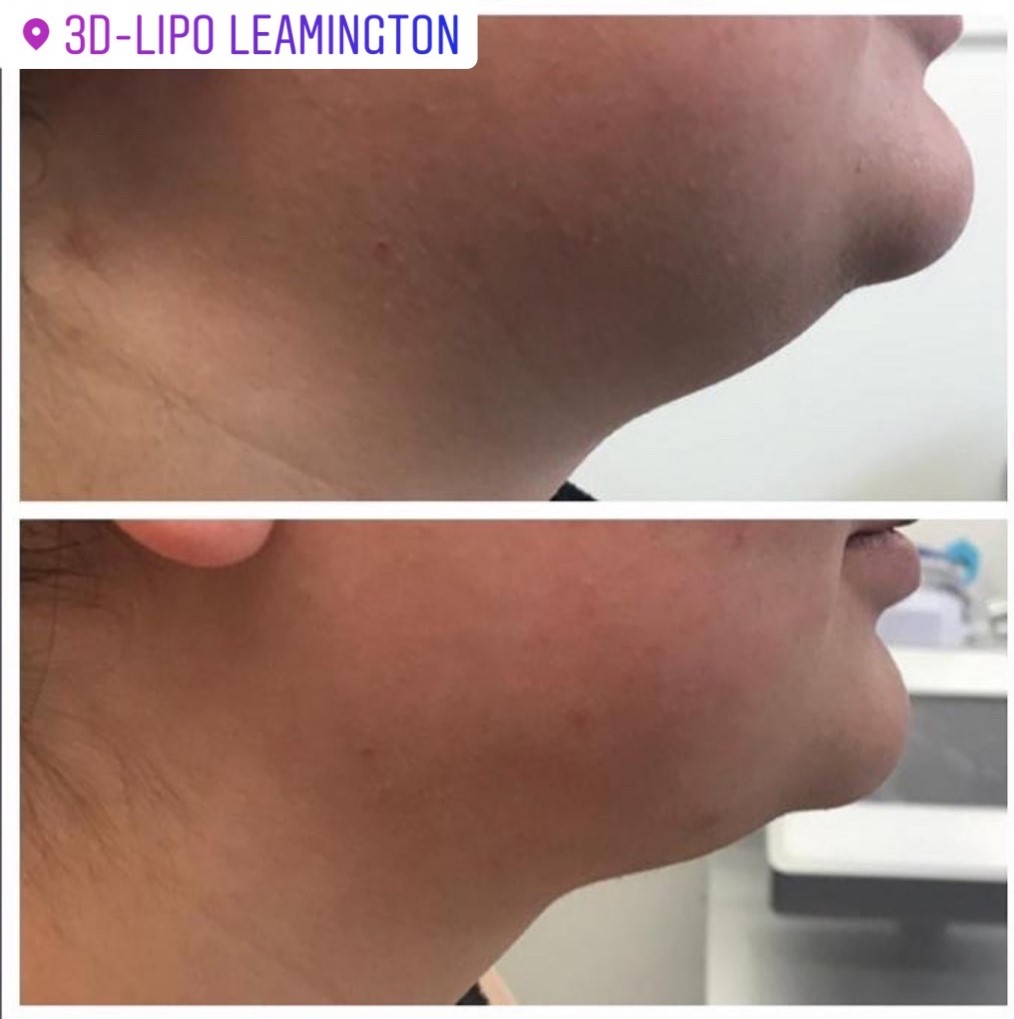 3D Chin Cryofreeze treatment at 3d lipo leamington