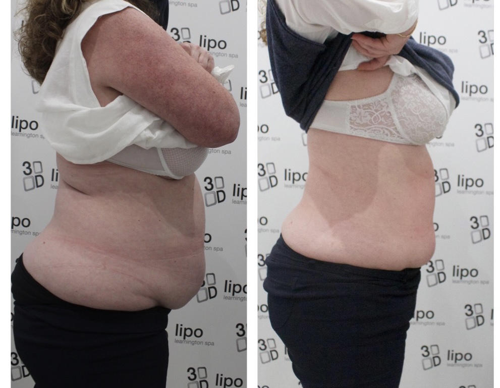 Non-Surgical Fat Reduction at 3D-lipo Leamington Spa treatment at 3d lipo leamington