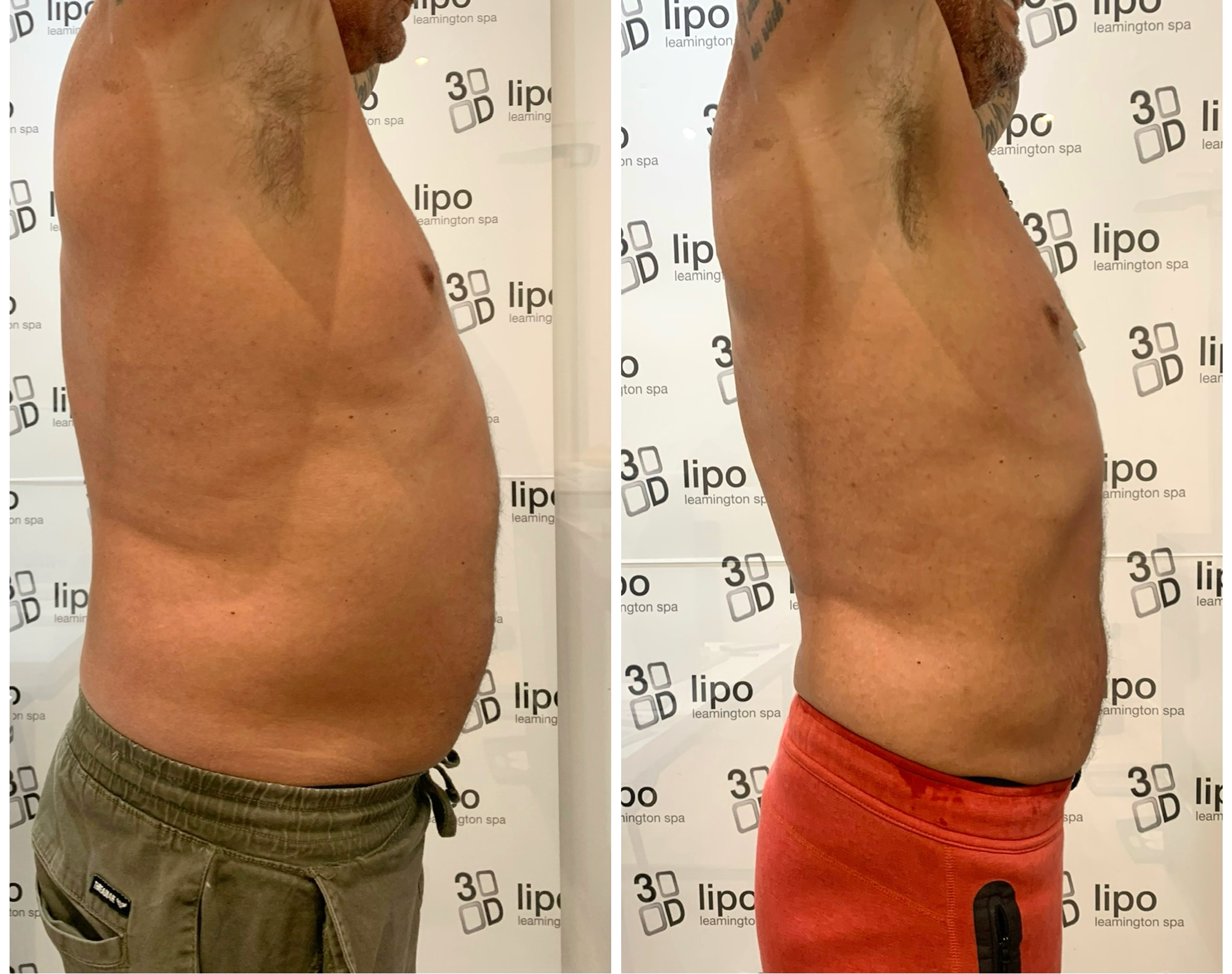Non-Surgical Fat Reduction at 3D Aesthetics Leamington Spa treatment at 3d lipo leamington