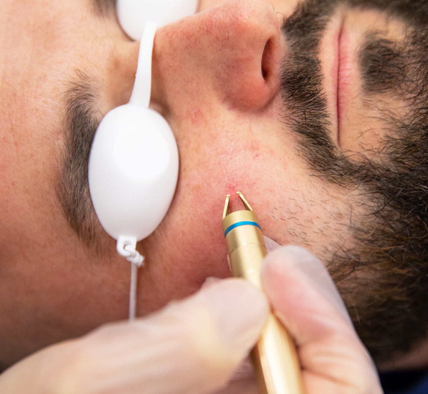 Thread Vein Removal