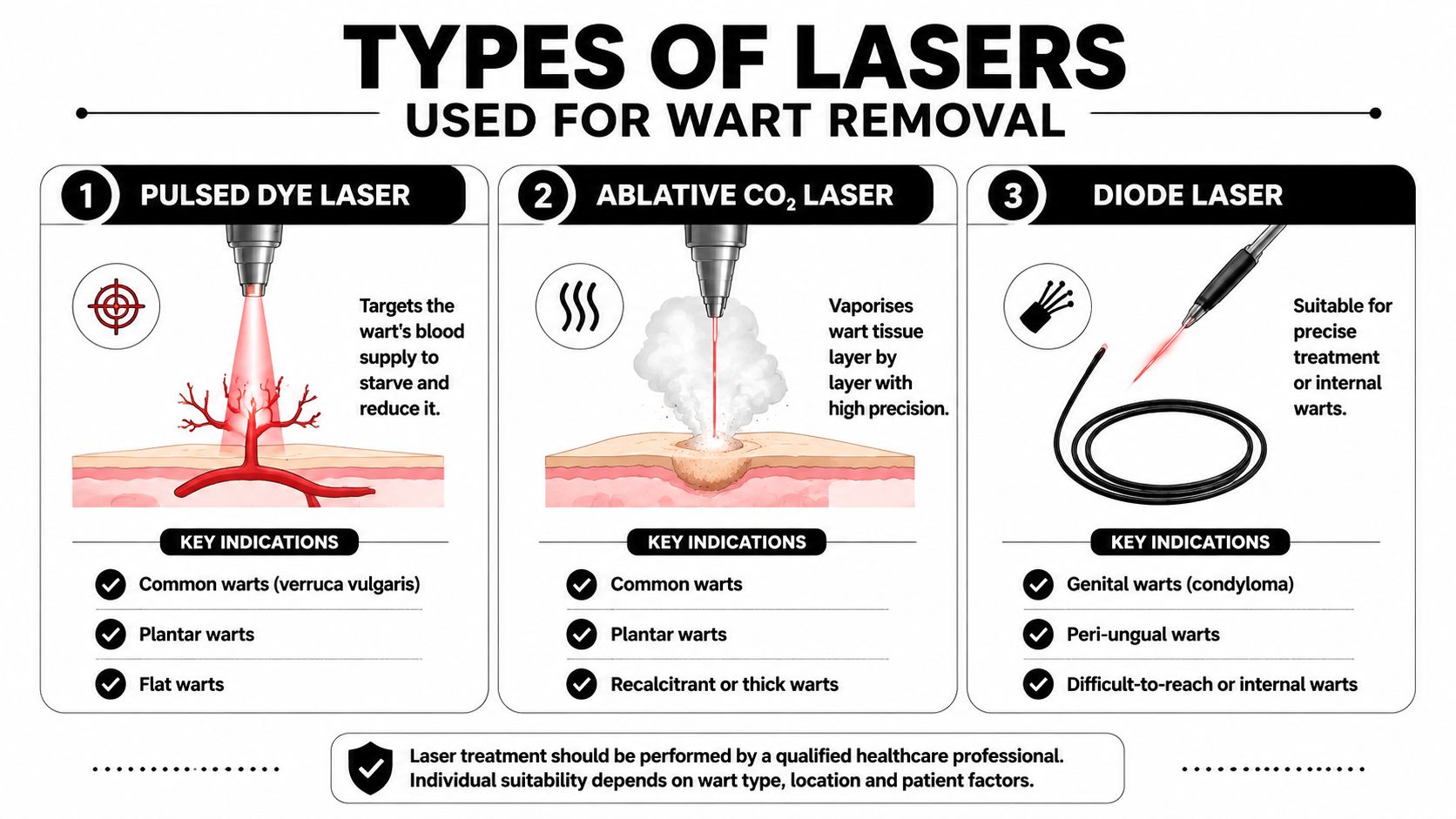 An infographic detailing three types of lasers used for medical wart removal and their key indications.
