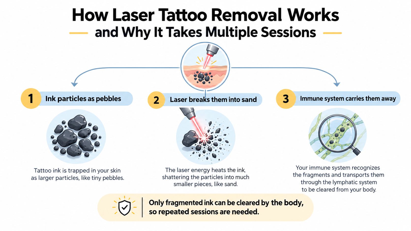 A diagram illustrating the three-step process of laser tattoo removal, showing ink particles breaking down for body clearance.
