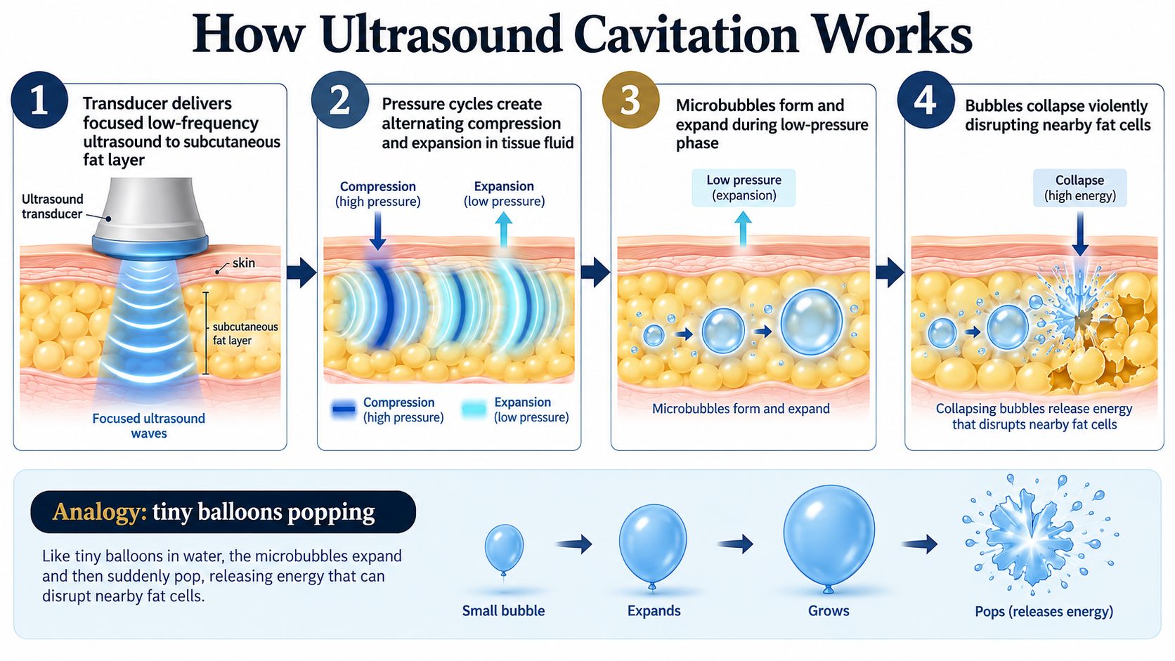 A diagram illustrating the four-step process of how ultrasound cavitation disrupts fat cells using microbubbles.