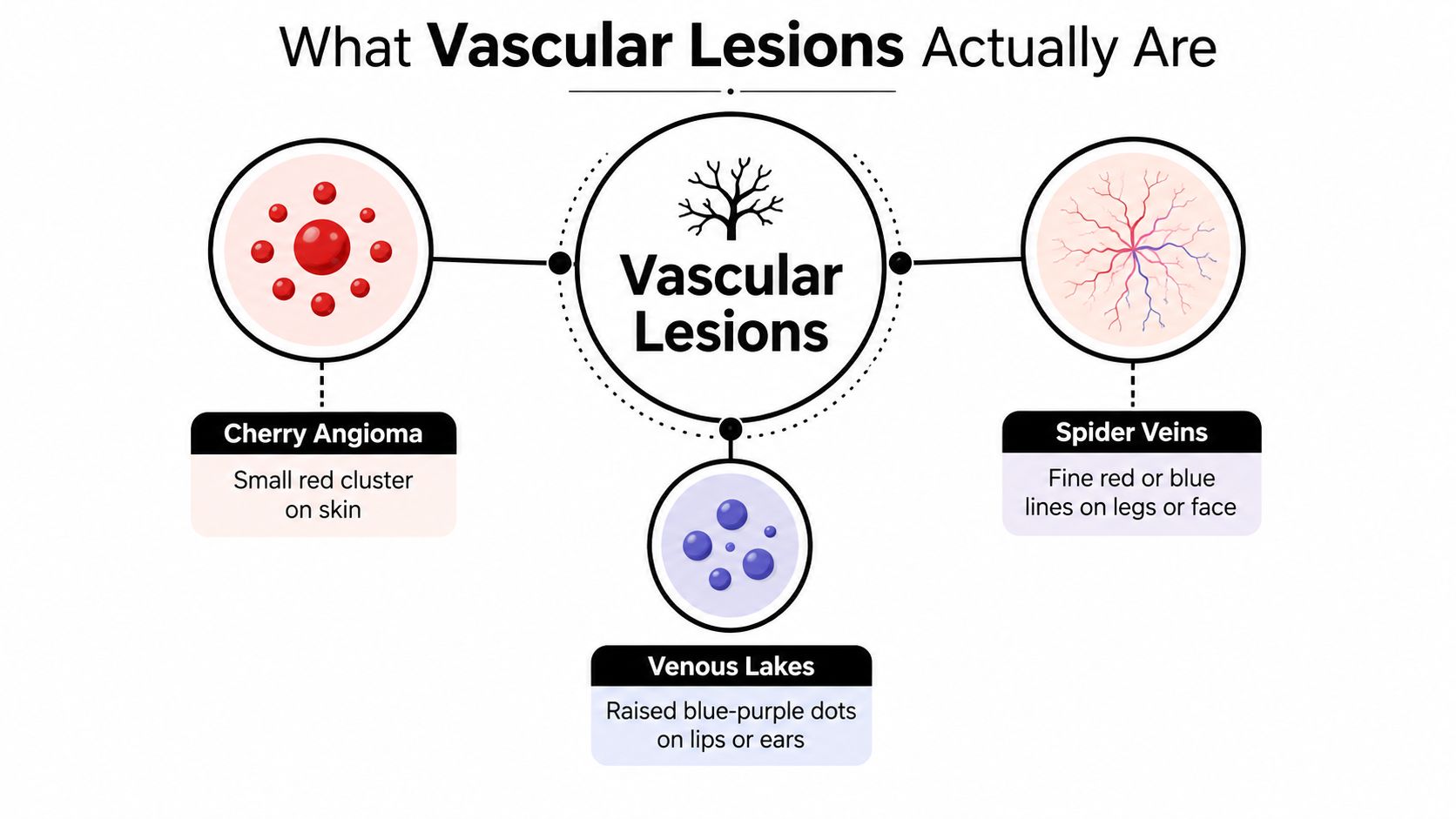 A diagram illustrating three types of vascular lesions including cherry angiomas, spider veins, and venous lakes.