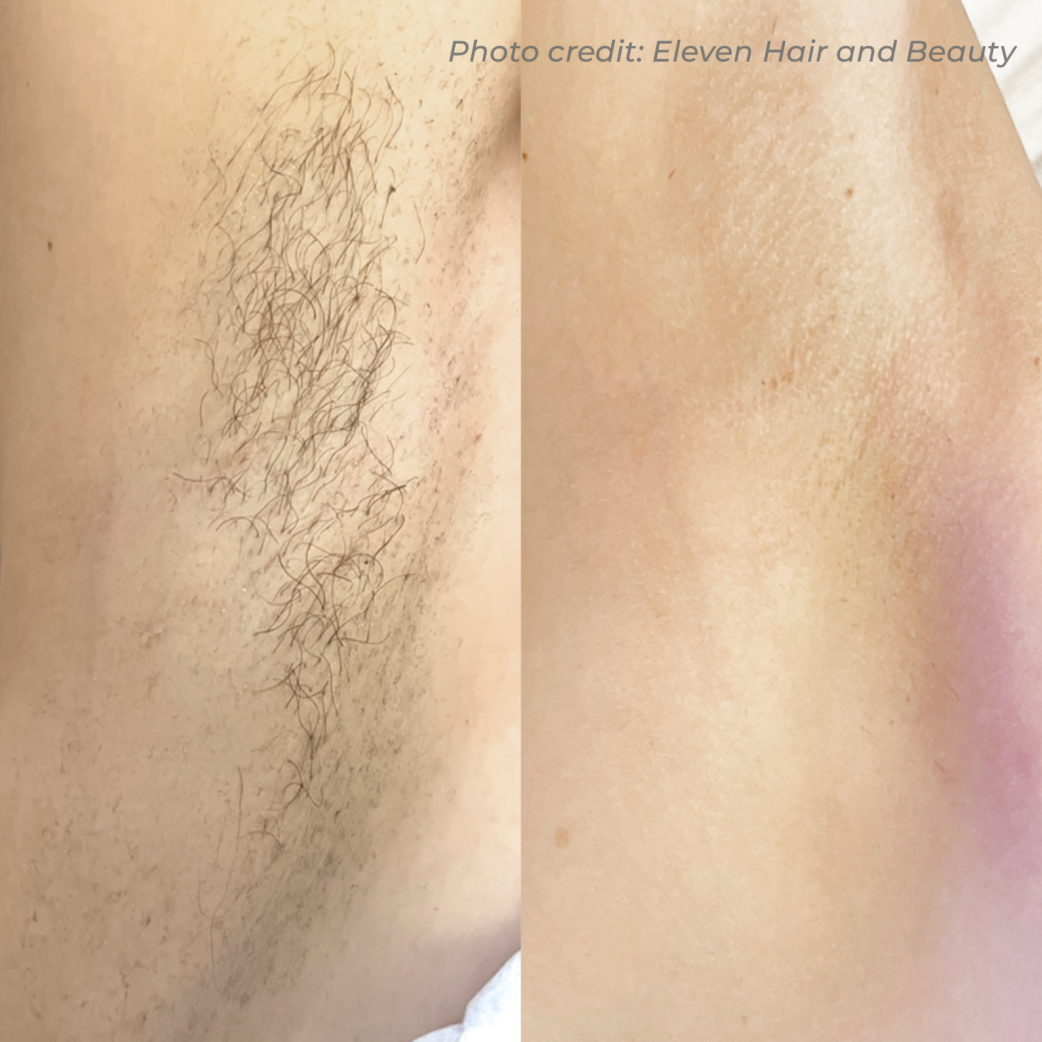 Laser hair removal before and after result 1