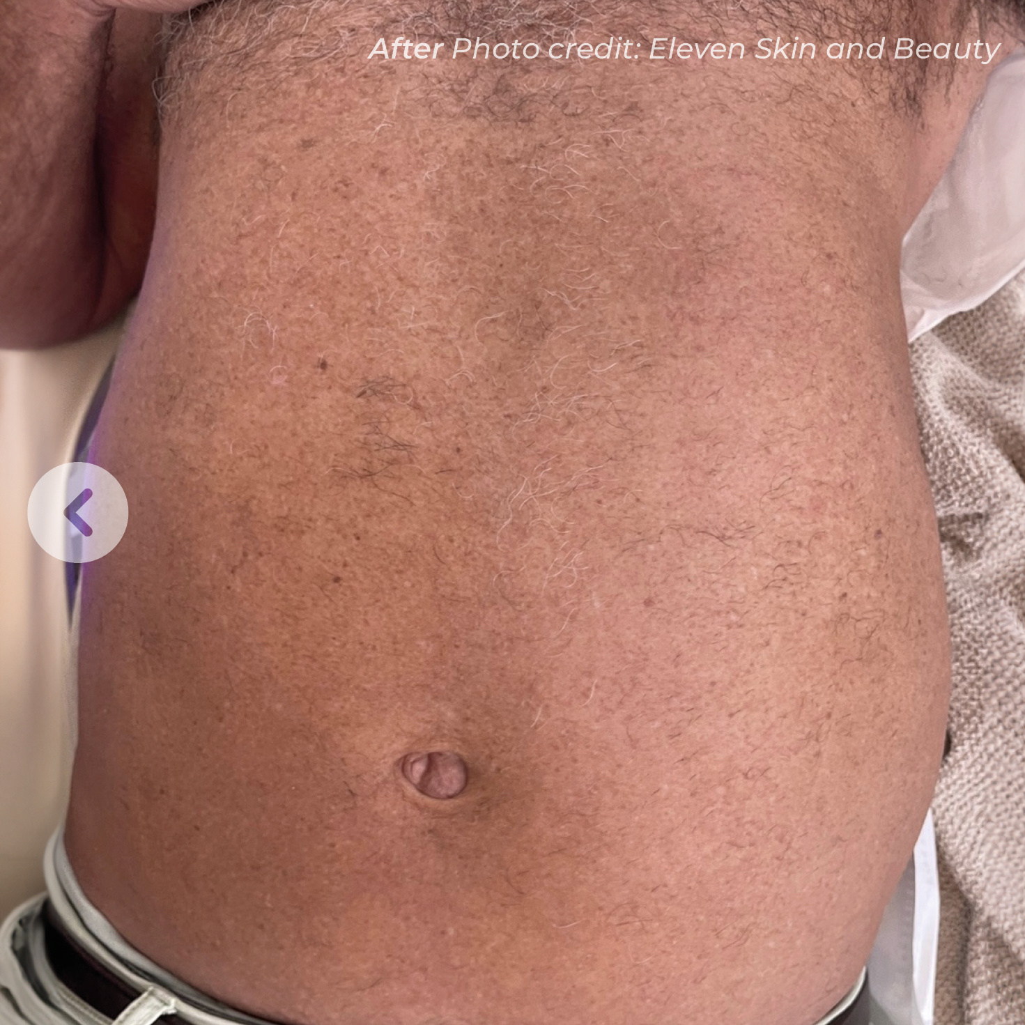 Client 2 after laser hair removal