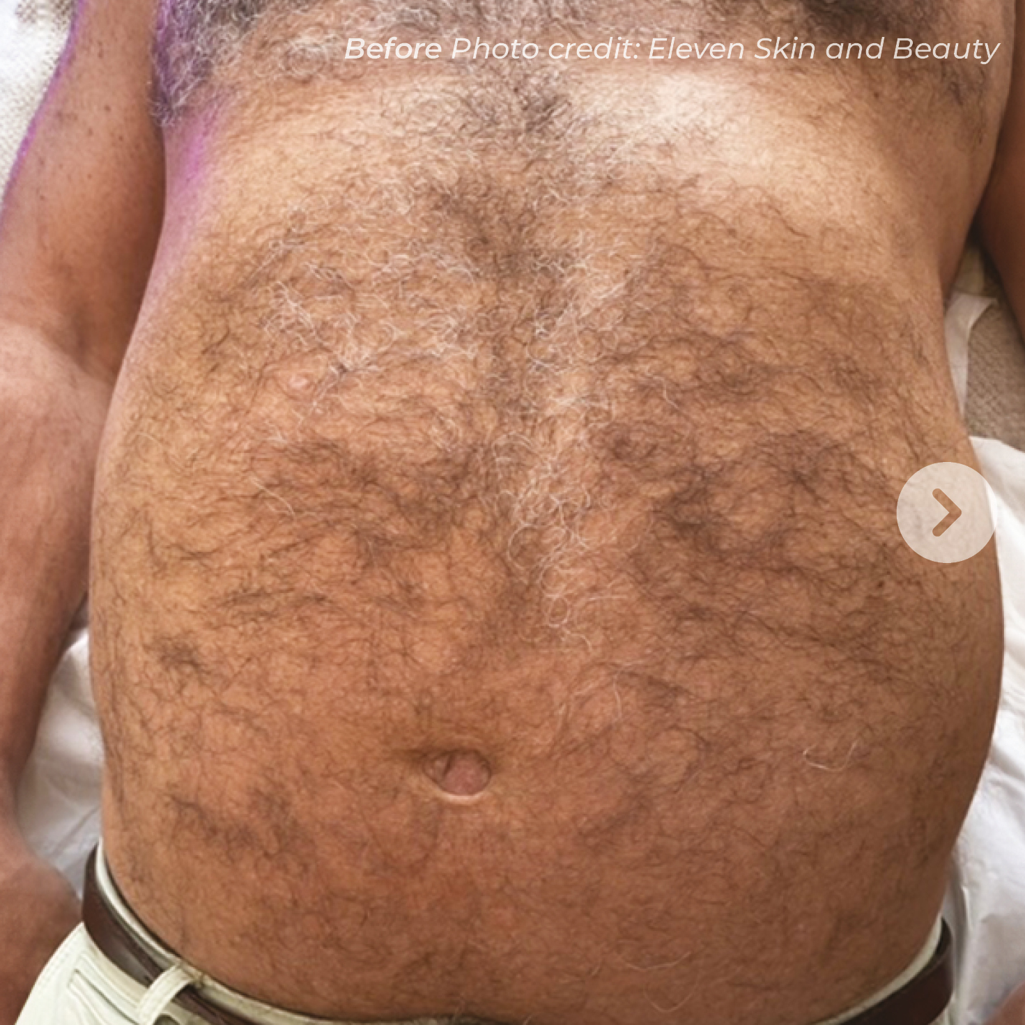 Client 2 before laser hair removal