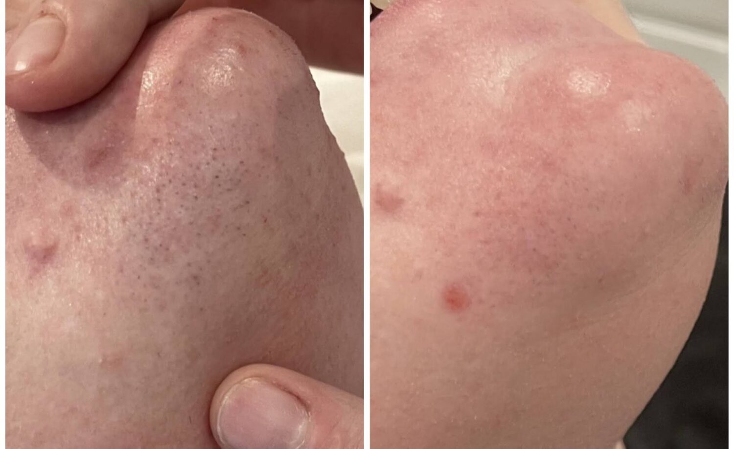 Laser hair removal before and after result 3