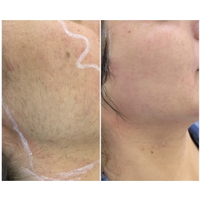 Laser hair removal before and after result 4