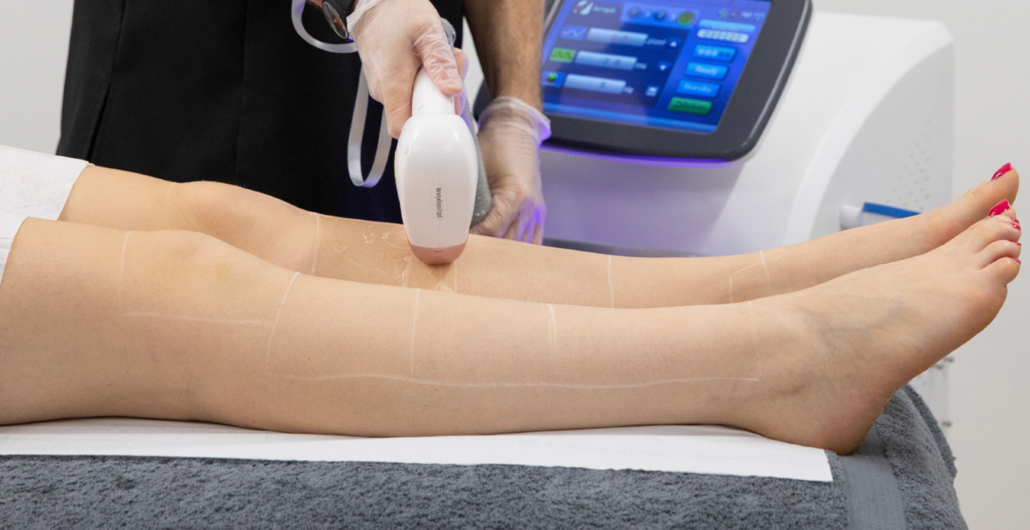 Laser Hair Removal