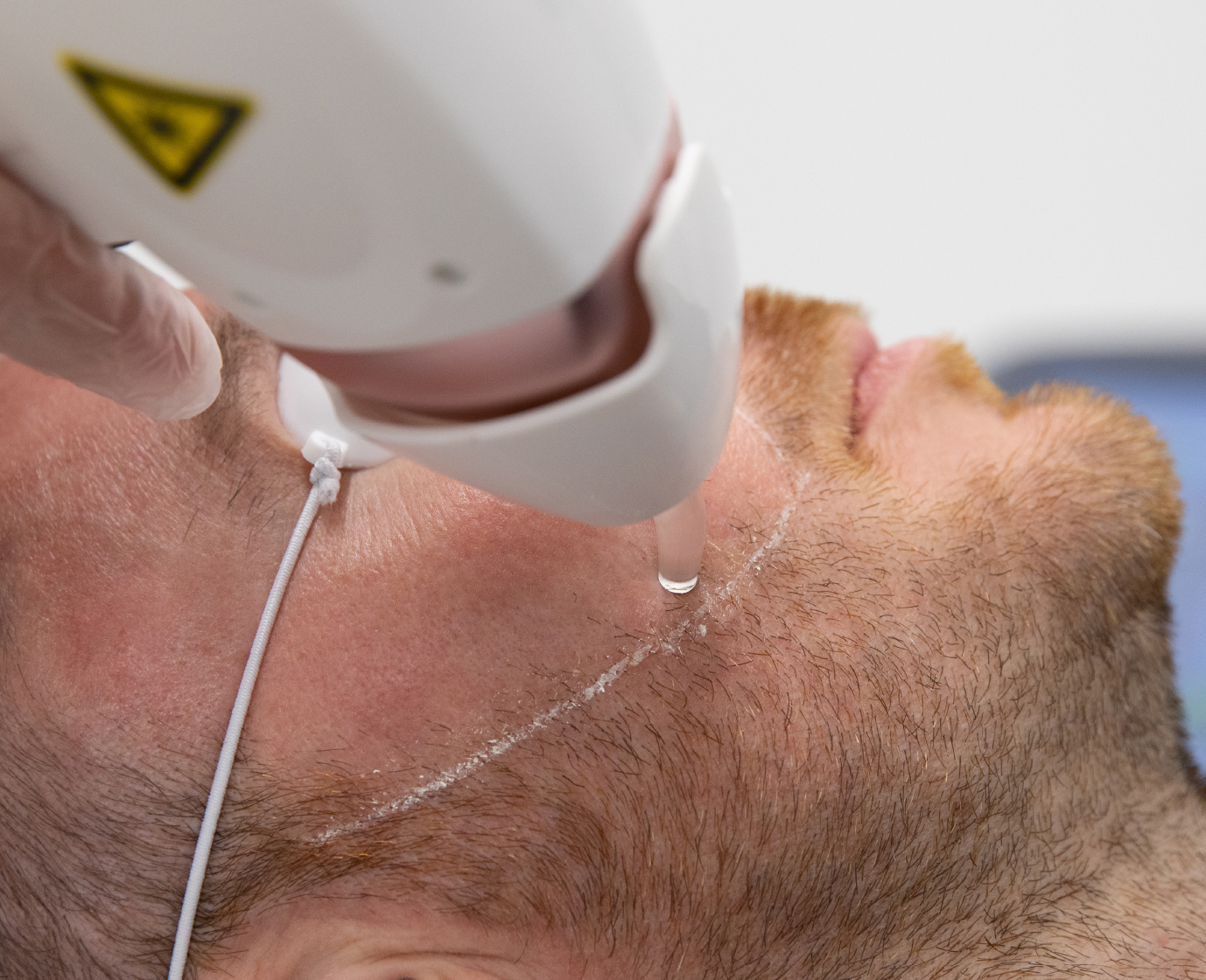 Laser hair removal at 3D Aesthetics Leamington