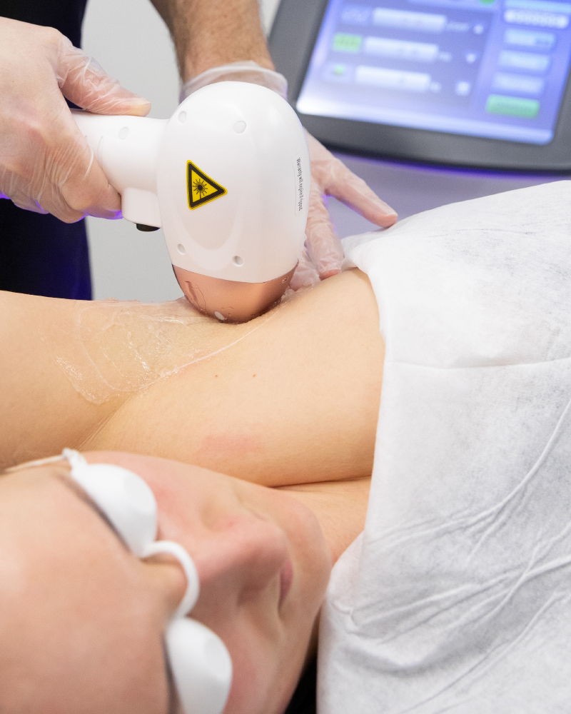 3D Trilogyice laser hair removal technology